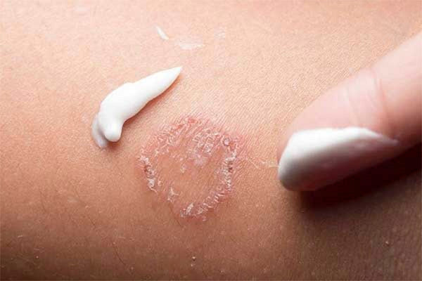 người bị lây nấm từ chó
