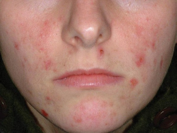 người bị nhiễm ghẻ demodex